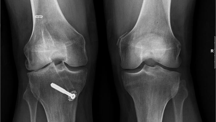 Petrick's-Knees None