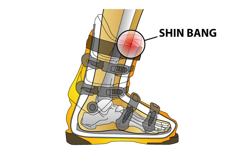 5 Causes of Shin Bang