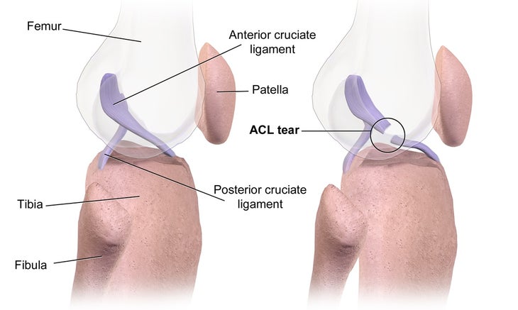 ACL Tear